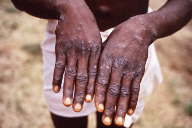 A case of monkeypox has been confirmed in England