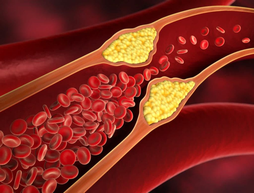 Are There Symptoms of High Cholesterol
