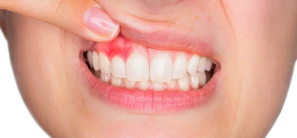 How to Manage Early Stage Gum Disease