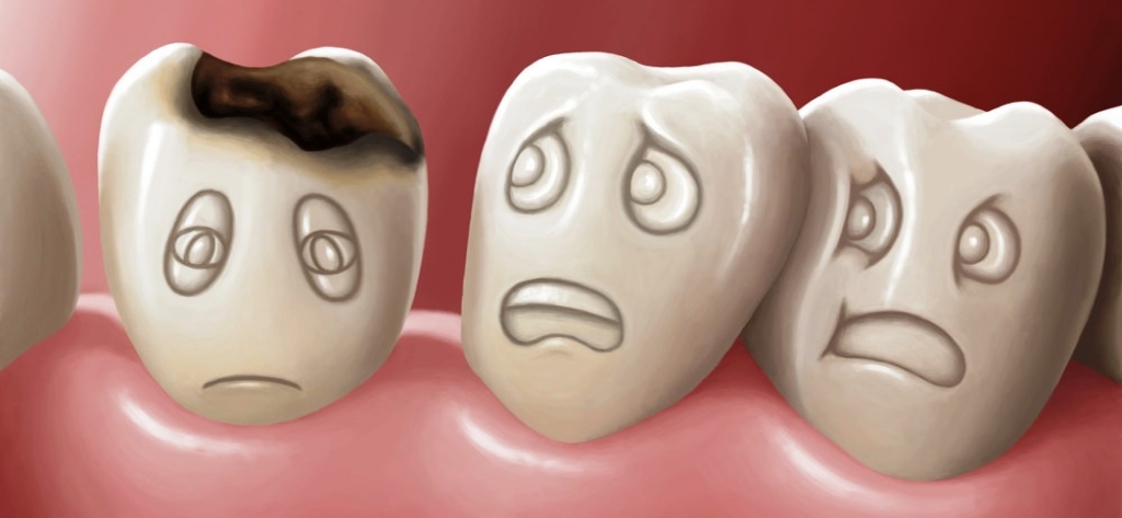 Tooth Decay Coral Springs Florida